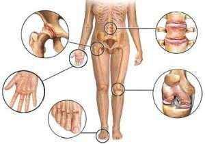 Ревматоїдний артрит: причини, симптоми, діагностика та лікування, що це таке