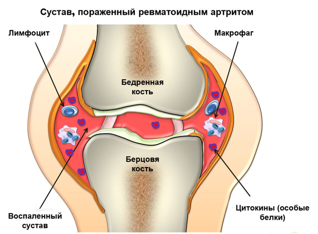 Турмалінові наколінники: при артрозі колінного суглоба, з магнітними вставками