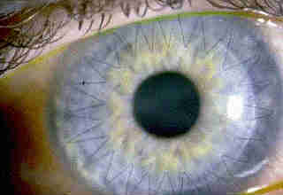 Пересадка рогівки ока (кератопластика): особливості трансплантації, відгуки про операцію
