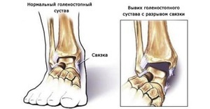 Вивих гомілковостопного суглоба, підвивих: причини, симптоми і лікування