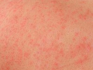 Лікарська алергія: причини, симптоми і лікування