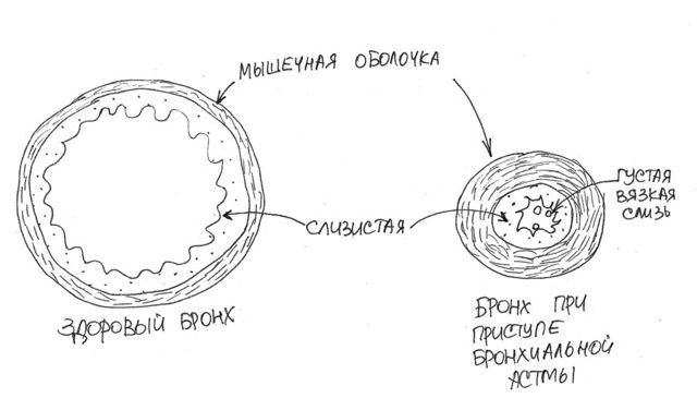 Алергічний нежить або риніт - симптоми, причини і лікування.