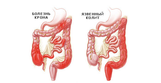 Від чого виникають різні патології кишечника?