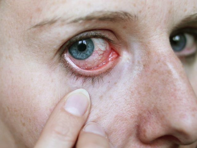 Чому сльозяться очі у дорослого, як лікувати, від чого можуть текти сльози