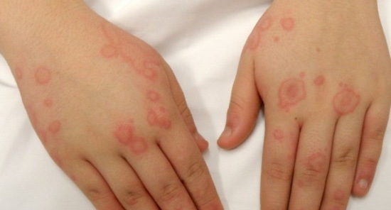Алергія на хлорку: симптоми в басейні і лікування у дітей