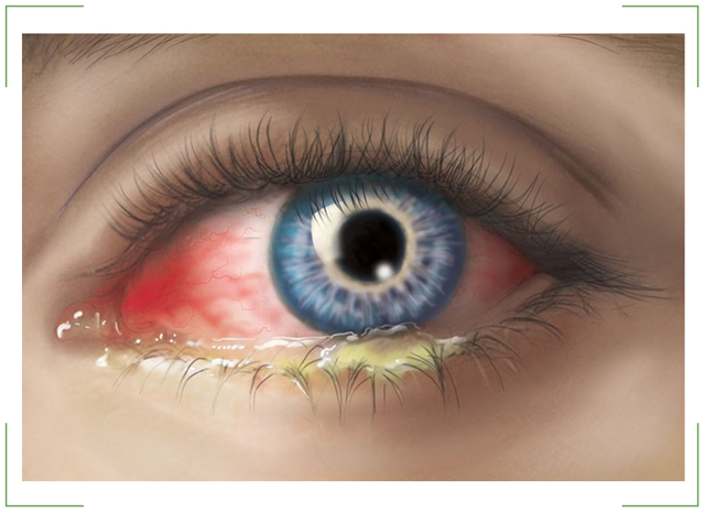 Кон'юнктивальний мішок ока: де знаходиться нижня і верхня порожнина, фото, функції