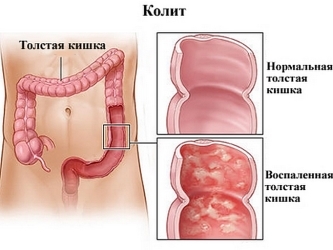 Псевдомембранозний коліт: симптоми і лікування патології