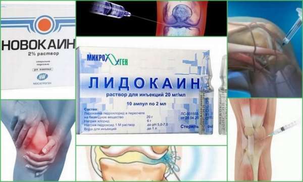 Блокада колінного суглоба: що це таке, ефективність, препарати, протипоказання