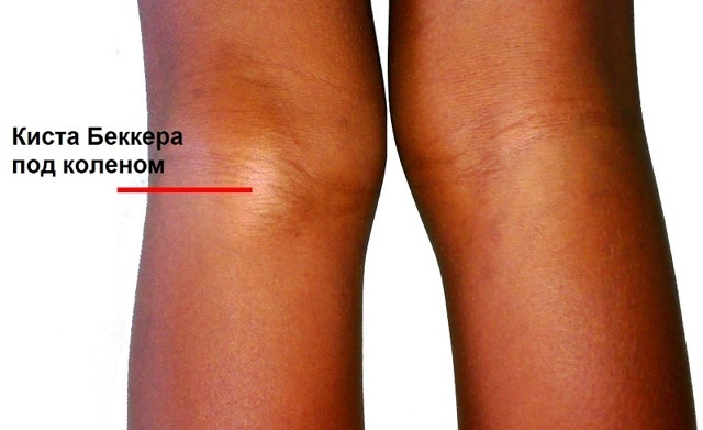 Лікування кісти Бейкера колінного суглоба в домашніх умовах, народними засобами