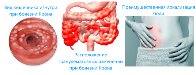 Ішемічний коліт кишечника: симптоми і лікування (дієта, медикаменти, хірургія)