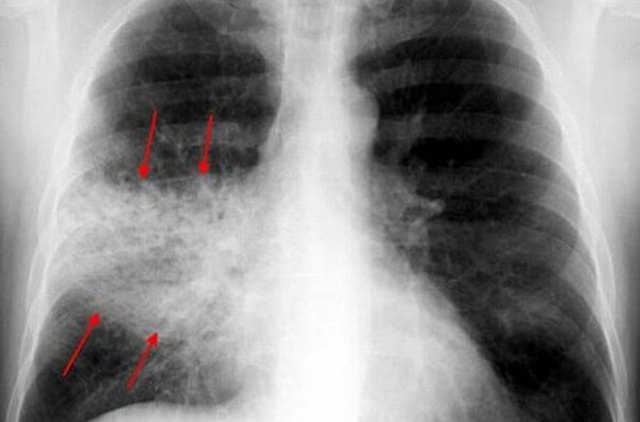 Пневмонія на рентгені - ознаки різних видів запалення легенів