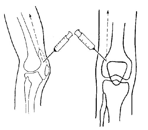 Пункція колінного суглоба: показання, техніка виконання, точки проколів, наслідки