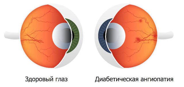 Ангіопатія сітківки: що це таке, причини, симптоми і лікування судин