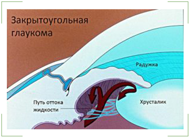 Закритокутова глаукома: причини, симптоми, лікування і профілактика гострих нападів