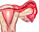 Аднексит і хронічний періаднексіт у жінок: симптоми і лікування
