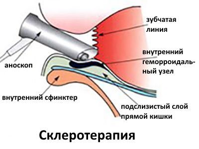 Аноскопія: суть процедури, підготовка і проведення обстеження