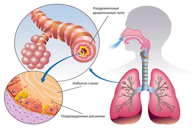 Бронхіт: класифікація, причини і лікування