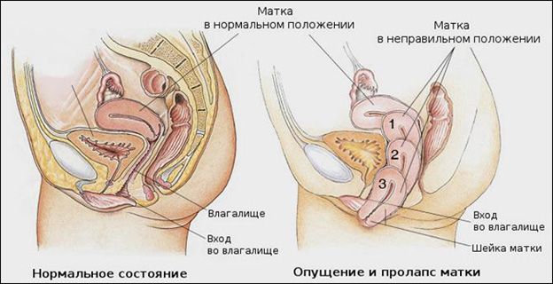 Опущення матки: як розпізнати і лікувати патологію