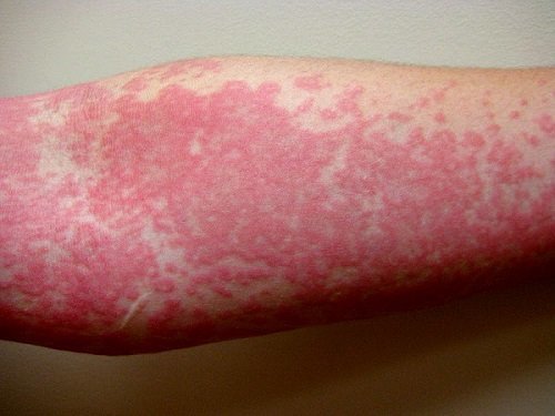 Алергія на побутову хімію: симптоми і лікування