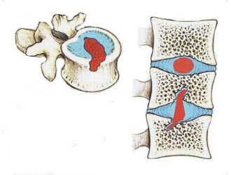 Грижа Шморля поперекового відділу хребта: що це, лікування, симптоми, причини