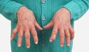 Ревматоїдний артрит: причини, симптоми, діагностика та лікування, що це таке