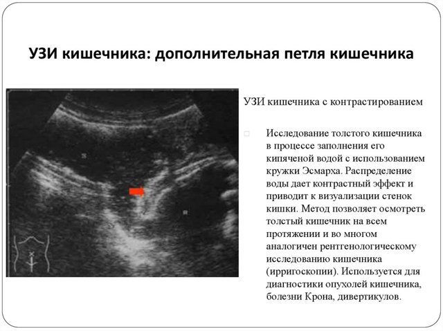 УЗД кишечника або колоноскопія:-яке дослідження краще і інформативніше?