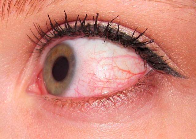 Що робити, якщо опухло верхню повіку ока: причини набряку, ніж лікувати припухлість