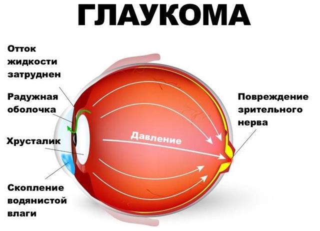 Болять очі: що робити, чому виникає біль в очних яблуках, причини