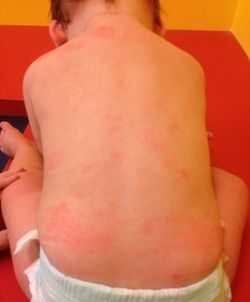 Алергія на хлорку: симптоми в басейні і лікування у дітей