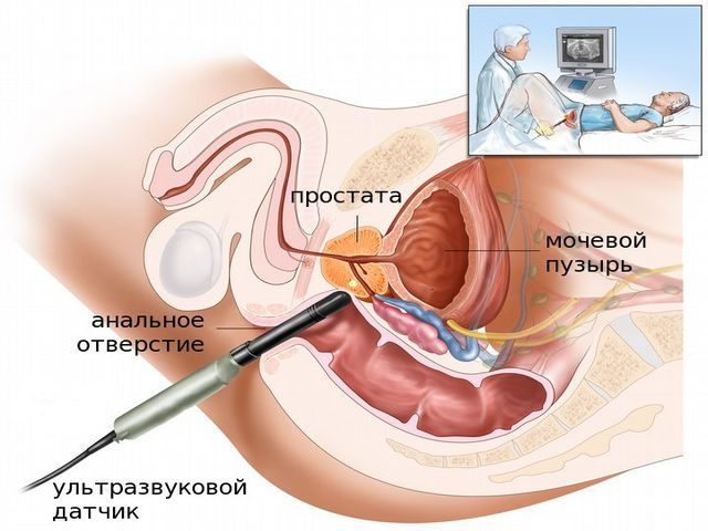 Збільшена простата: що робити, лікування гіпертрофії у чоловіків і причини зростання