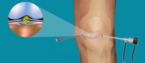 Реабілітація після артроскопії колінного суглоба: три фази відновлення