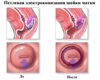 Профілактика раку шийки матки: причини, симптоми, види
