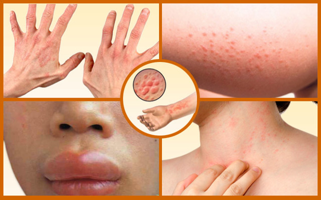 Алергія на духи і парфуми: симптоми, лікування і профілактика