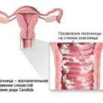 Молочниця при цукровому діабеті у жінок: симптоми, способи лікування