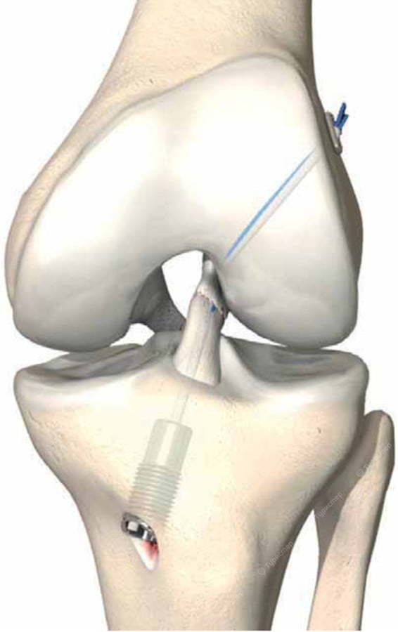 Розрив передньої хрестоподібної зв'язки колінного суглоба: повний, частковий