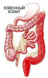 Ілеоколіт: кишкові і загальні симптоми, лікування (дієта, препарати)
