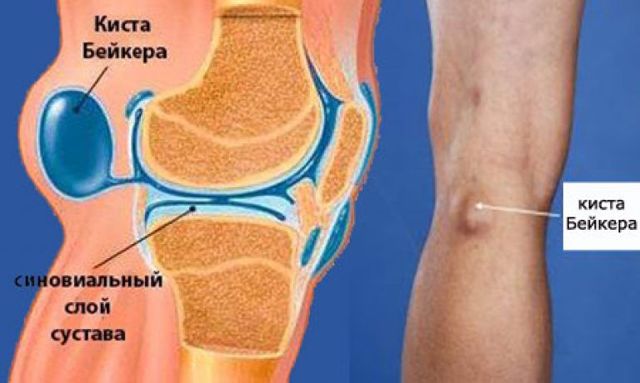 Лікування кісти Бейкера колінного суглоба в домашніх умовах, народними засобами
