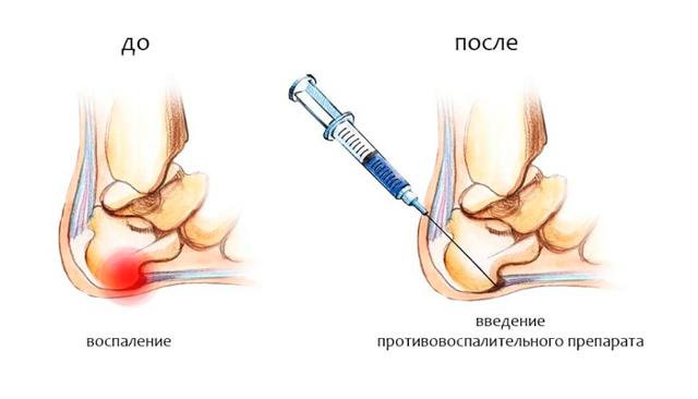 Бурсит п'яти: що це таке, причини, симптоми, діагностика та лікування