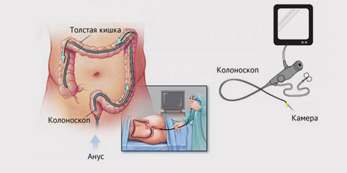 УЗД кишечника або колоноскопія:-яке дослідження краще і інформативніше?