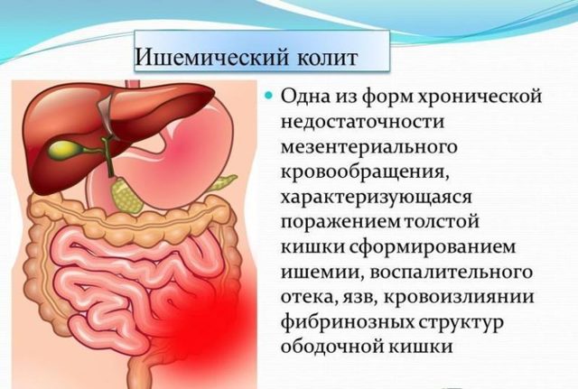 Ішемічний коліт кишечника: симптоми і лікування (дієта, медикаменти, хірургія)