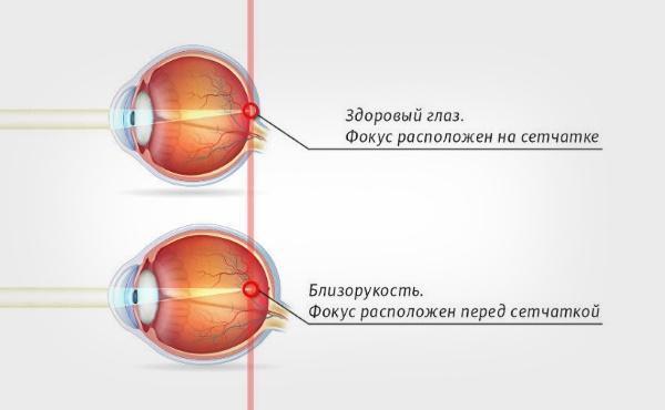 Вроджена міопія (короткозорість) у дітей, лікування високого ступеня у дитини