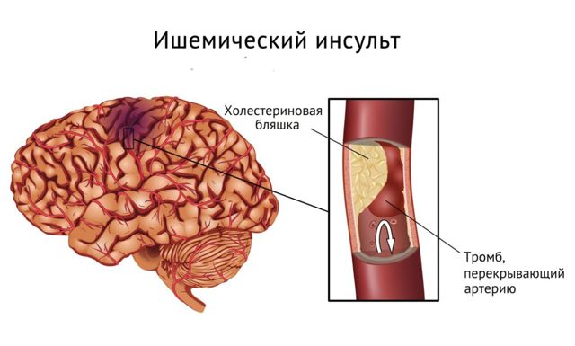 Ангіопатія сітківки: що це таке, причини, симптоми і лікування судин