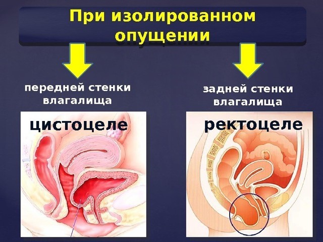 Опущення матки: як розпізнати і лікувати патологію