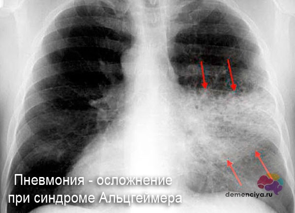 Стадії Альцгеймера: як розпізнати хворобу, діагностика та лікування хвороби