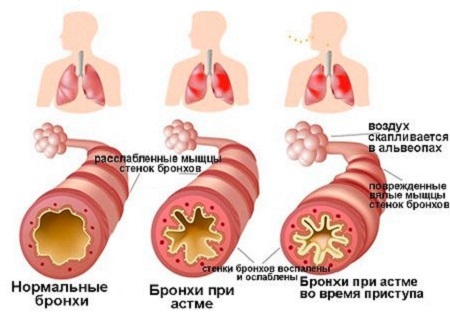 Бронхоспазм - причини, симптоми і лікування