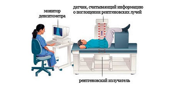 Діагностика остеопорозу у жінок і чоловіків: аналіз крові, денситометрія