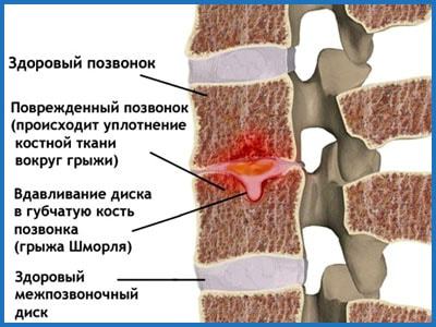 Грижа Шморля поперекового відділу хребта: що це, лікування, симптоми, причини