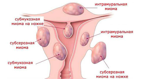 Міома матки: основні причини, симптоми і лікування