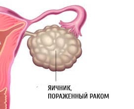 Причини болю в яєчниках у жінок і як лікувати