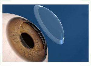Пересадка рогівки ока (кератопластика): особливості трансплантації, відгуки про операцію